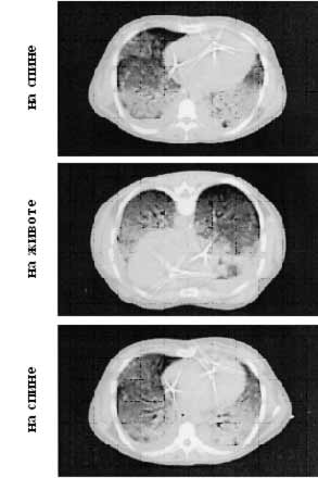 Рисунок 1. Компьютерная томограмма грудной клетки больного с ОРДС в конце выдоха: распределение плотностей в лёгких в положении.
